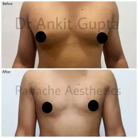 Gynecomastia correction before and after in Delhi — firm, flat chest by Dr. Ankit Gupta